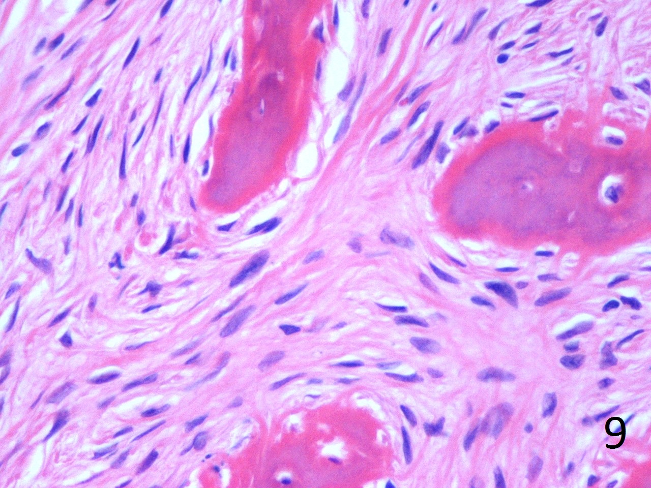 Polyostotic Fibrous Dysplasia Histology